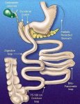 Duodenal Switch