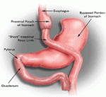 Gastroplastia com Y-de-Roux