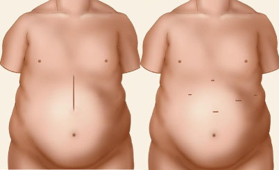 Cirurgia Convencional x Cirurgia Laparoscópica Cirurgia Convencional x Cirurgia Laparoscópica