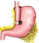 Gastroplastia Vertical com Bandagem