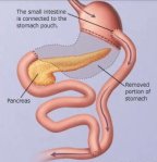 Operação de Scopinaro